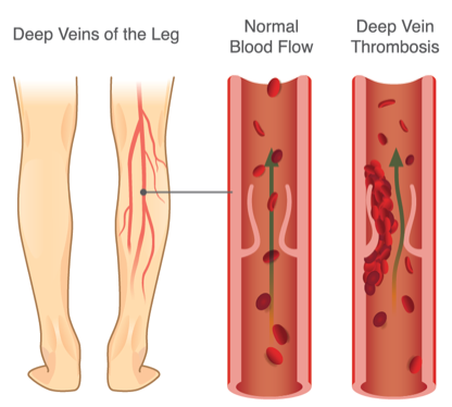 DVT 1 DVT 1
